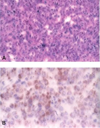 Fig.  3A  e  B  –  Exame  histológico: A)  Coloração  pela  hemato- hemato-xilina-eosina (x400); B) Coloração pela enolase especíﬁ ca dos  neurónios (x800).