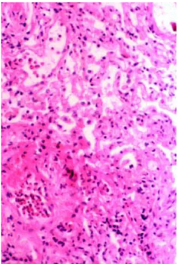 Fig. 2 – Lavado broncoalveolar Fig. 3 – Biopsia transbronquica