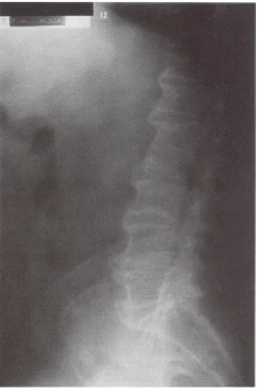 Fig. 2 –  Mieloma múltiplo e SIDA (um caso clínico) – Radiografia da coluna dorso- dorso-lombo-sagrada em 2001: fracturas de D12 a L3