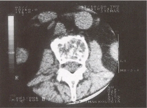 Fig. 3 – Mieloma múltiplo e SIDA (um caso clínico) – TAC coluna lombo-sagrada em  1997: múltiplas e pequenas lesões líticas; fractura de L2; deformação em cunha, de  vértice anterior, do corpo vertebral por afundamento do planalto superior