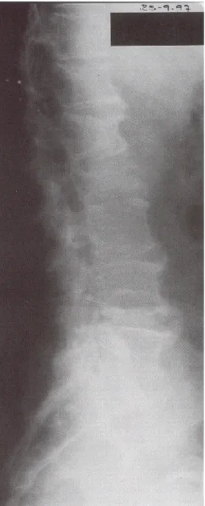 Fig. 1 –  Mieloma múltiplo e SIDA (um caso clínico) – Radiografia da coluna dorso- dorso-lombo-sagrada em 1997: fracturas de D12 a L1