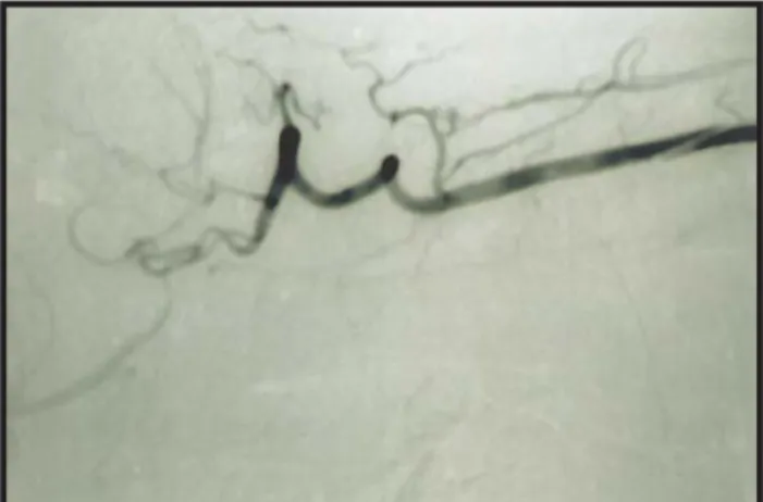 Fig. 4 - Biópsia cutânea – quadro morfológico de vasculite no- no-dular com atingimento de vasos de pequeno e médio calibre compatível com Poliarterite Nodosa.