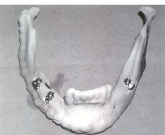Fig. 4 – Disk implants inserted in reconstructed mandible