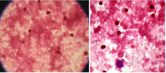 Figure 2. Negative NBT test, when A represent NBT test from blood derived by subject 1 after 24 hours at the beginning of treatment and B represent  NBT test from blood derived by subject 2 after 24 hours at the beginning of treatment (400X) 