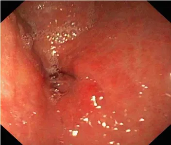 Fig. 1 – Endoscopic appearance of mucosa-associated  lymphoid tissue (MALT) lymphoma of the stomach antrum: 