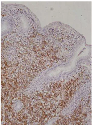 Fig. 4 – Intensive expression of CD 20 antigen in mucosa- mucosa-assasiated hymphoid tissue (MALT) lymphoma  