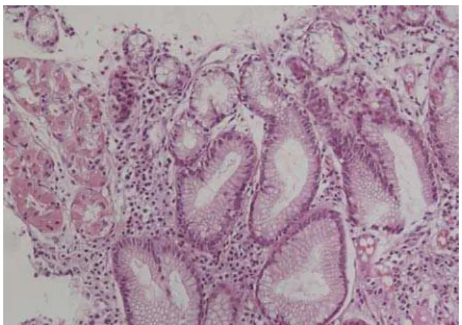 Fig. 5 – Effect of H. pylori eradication therapy: a rare  lymphocytic infiltrate with typical foveolar hyperplasia of 