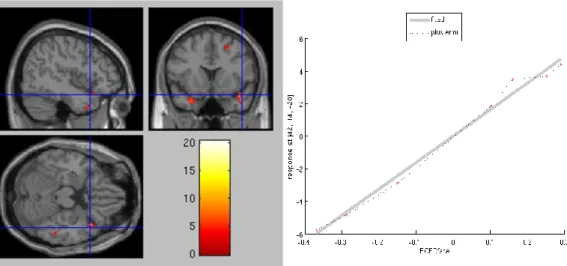 Fig. 2. T-map of SPM correlation (height threshold: Z =4.032, p&lt;0.005 unc.) between resting brain perfusion and FD to the face in the  videoclip, in a group of 7 patients with ASD