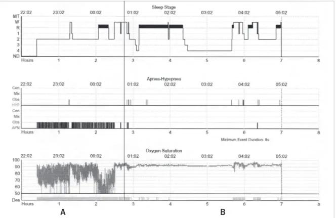 Fig. 2 – Example of a compressed overnight polysomnographic graph in a patient with marked obstructive sleep apnea followed by the introduction of  nasal CPAP