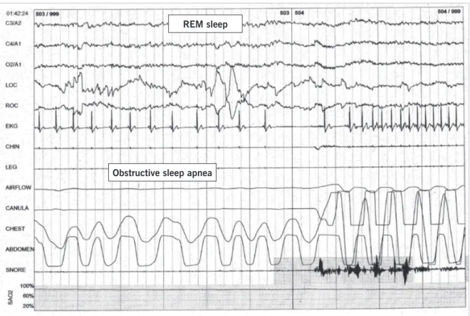 Fig. 3 – Example of a thirty-second epoch graphic containing an obstructive sleep apnea event with sinus pause followed by increment in heart rate