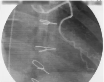 Fig. 6 - A “no touch” saphenous graft anastomised to a 1-mm diameter coronary artery