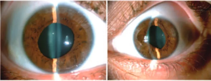 Figure 1 - Right and left eye anterior segment photograph.