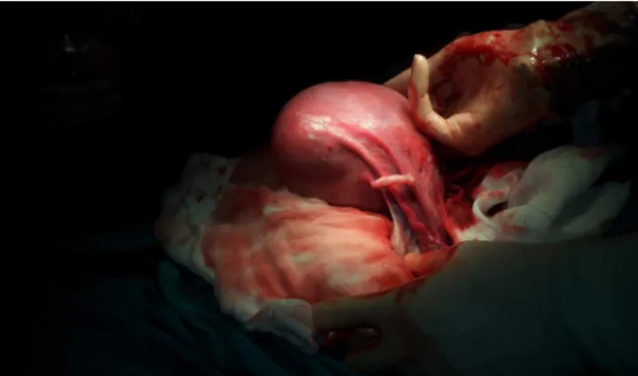 Figure 1. Right side view of uterus while performing cesarean section surgery