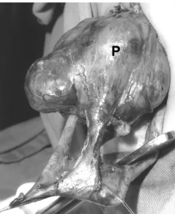 Figure 2 – Intra-operative finding of cake kidney. Note the di- di-lated extra-renal pelvis (P) and single ureter.
