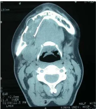 Figure 1. Preoperative panoramic radiograph shows the multilocular lucency  extending from the neck of condyle to the right canine tooth (Case 1).