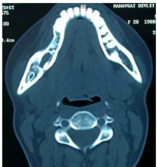 Figure 4. Computed tomography scan axial image at the end of 2  year follow-up period shows no signs of the recurrence (Case 1).
