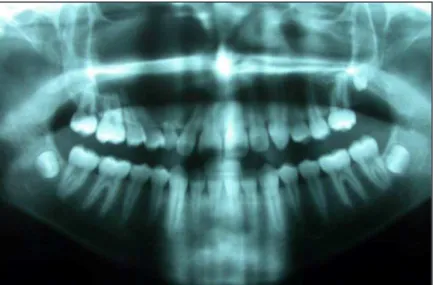 Figure 8. Preoperative panoramic radiograph shows an expansible lesion  extending from the primary canine tooth to the third molar region and superiorly  to the loor of the orbit (Case 2).