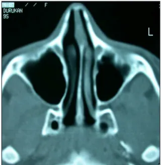 Figure 12. Computed tomography scan axial image at the end of  2 year follow-up period shows no signs of the recurrence (Case 2).