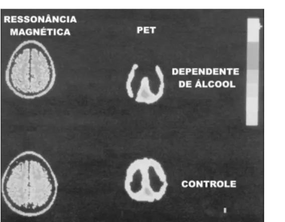 Figure 1- Magnetic Resonance (MR) and Positron Emission Tomography (PET) images in one alcohol-dependent subject (top part) and one healthy volunteer (control, bottom part)