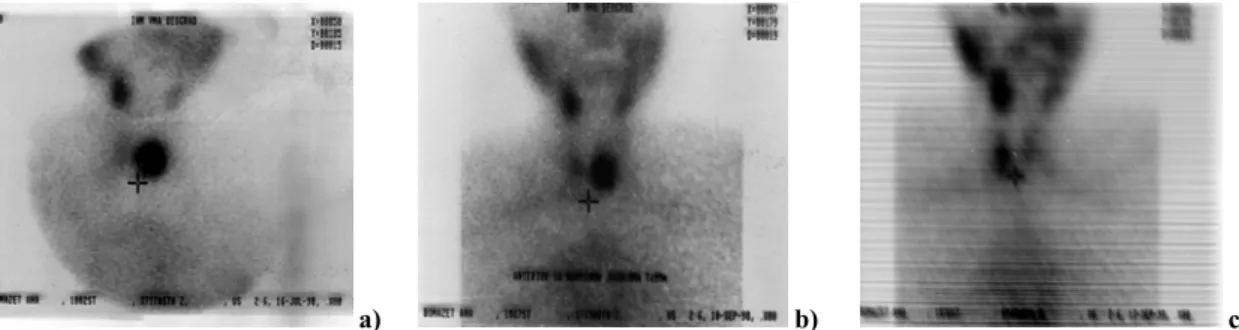 Fig. 3 – Scintigraphic appearance of a nodule in the left lobe of the thyroid before, immediatly after percutaneous ethanol injection   (a and b) and one year later (c)