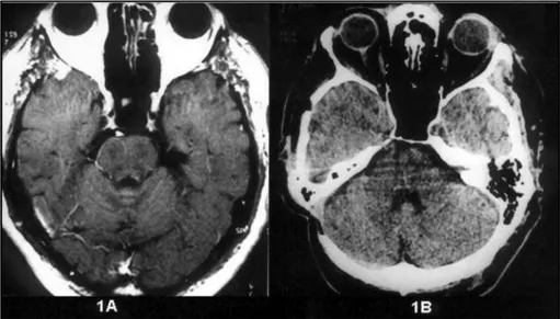 Fig 1. Normal neuroradiological investigation.  Post contrast T1-weighted axial M RI scan (1A) and axial CT (1B).