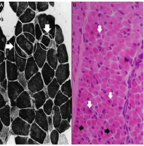 Figure 2 Cross-sectional histological sections of striated muscle (freezing). (A) Miopatia da parte central, or central core myopa- myopa-thy: the horizontal arrow indicates a muscle fiber with unmarked central circular area (core); the vertical arrow depi