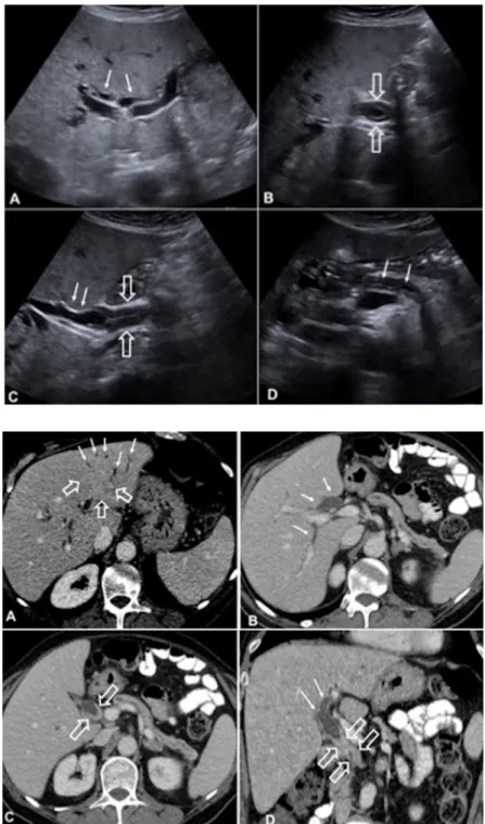 Figure 1 – Ultrasound. (A) Axial plane, showing  bilateral dilatation of  the intra-hepatic biliary ducts  (arrows)