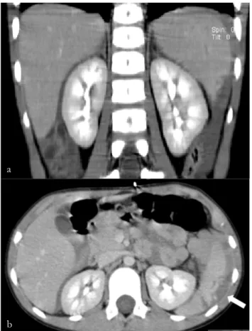 Figure 1 – Contrast-enhanced coronal (a) and axial (b) CT. Splenic  parenchyma laceration evolving the lower pole with subacute hematoma  (arrow)
