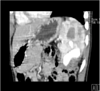 Figure 4 – a) Celiac arteriogram revealing the pseudoaneurysm  (arrow)    in  the  inferior  splenic  pole