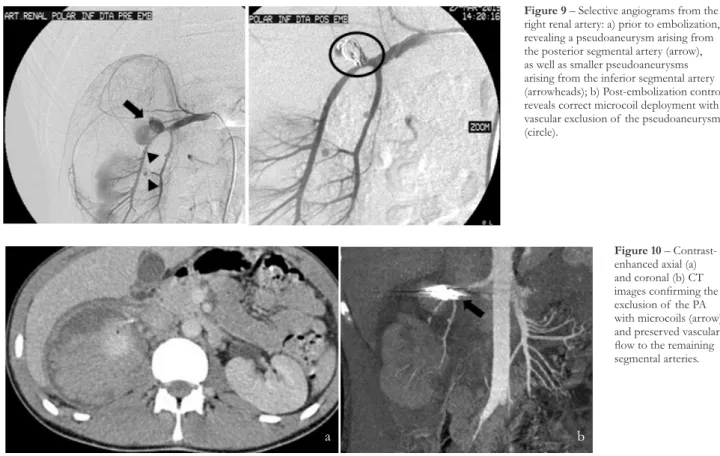 Figure 9 – Selective angiograms from the  right renal artery: a) prior to embolization,  revealing a pseudoaneurysm arising from  the posterior segmental artery (arrow),  as well as smaller pseudoaneurysms  arising from the inferior segmental artery  (arro