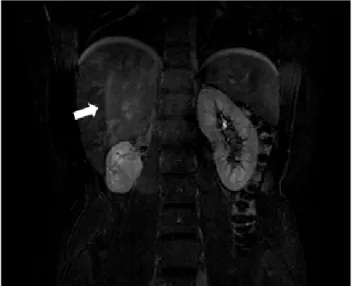 Table 1 - The American Association for the Surgery of  Trauma grading system for blunt injury of  the liver, spleen and kidneyFigure 11 – T1-weighted contrast enhanced coronal MR image