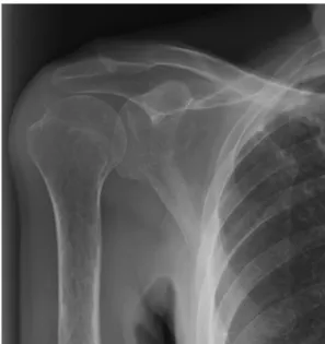 Figura 1 – Radiograma do ombro direito em incidência AP (6  meses após início de sintomas) mostra evidência de osteopenia  de desuso, sem evidência de alterações degenerativas, traços de  fratura  ou  sinais  de  instabilidade