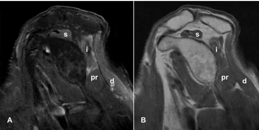Figura 4 – Estudo por RM  do ombro direito (18 meses  após início de sintomas) com  imagens sagitais ponderadas 
