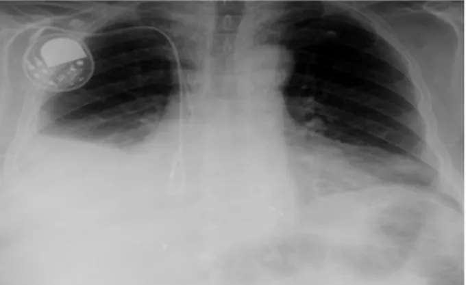 Figure 1 – Initial thoracic x ray at admission on December 2014 shows  large right pleural effusion and enlarge cardiac silhouette in a patient with  cardiac pacemaker.