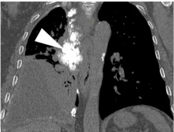 Figure  3  –  Follow-up  contrast-enhanced  thoracic  CT  at  August  2015  (6  months  after  the  initial  examination)  continue  to  reveal  right   water-density pleural effusion and “de novo” small, coarse pleural calci-fications  (arrowheads)