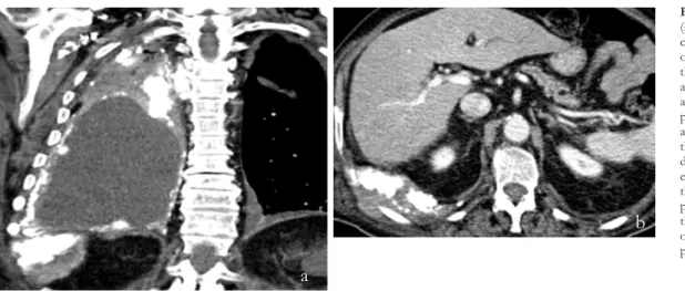 Figure 8 – Coronal  (a) and axial (b)  contrast-enhanced CT  one month later shows  the development of   a soft tissue mass  at the site of the  pleural calcifications  at lung base, invading  the ribs and direct  diaphragmatic  extension of   the tumor to