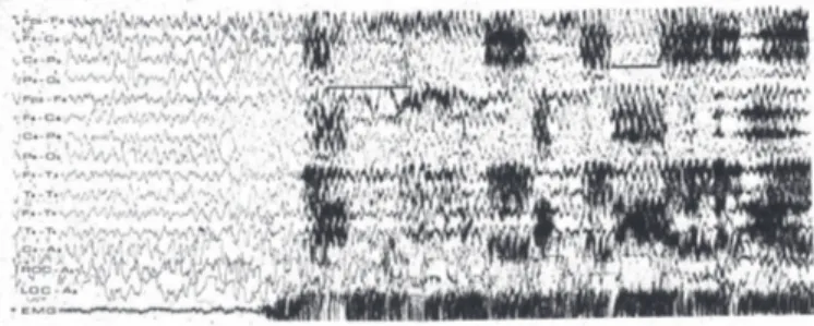 Figure 1 - Example of stage 4 NREM sleep (delta waves):