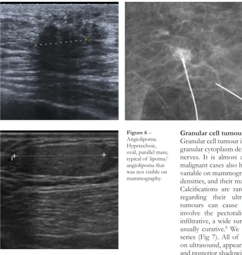 Figure 5 – Fibromatosis (desmoid-type). 
