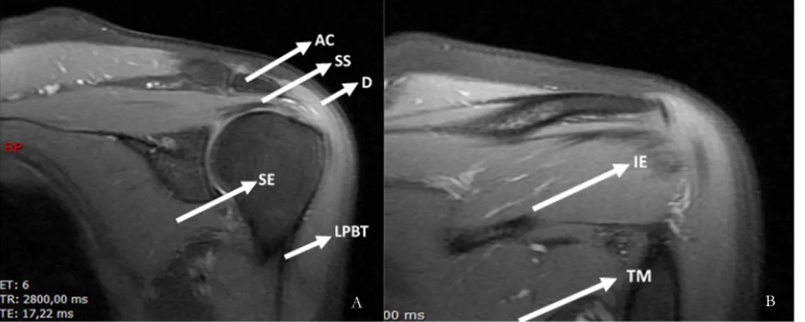 Figure 1 – Coronal oblique  PD FS depicting normal  rotator cuff  anatomy. A)  AC: acromio-clavicular  joint, SS: supraspinatus  tendon; D: deltoid muscle; 