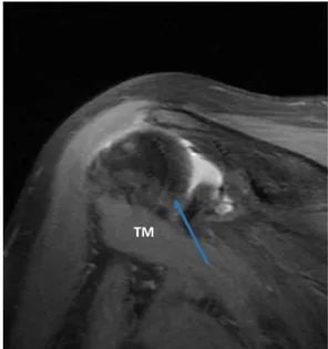 Figure 7 – In the previous setting of  complete (full width  and full thickness) supraspinatus tear, PD FS coronal oblique  evaluation demonstrates concomitant complete tear of  the  infraspinatus tendon (blue arrow)