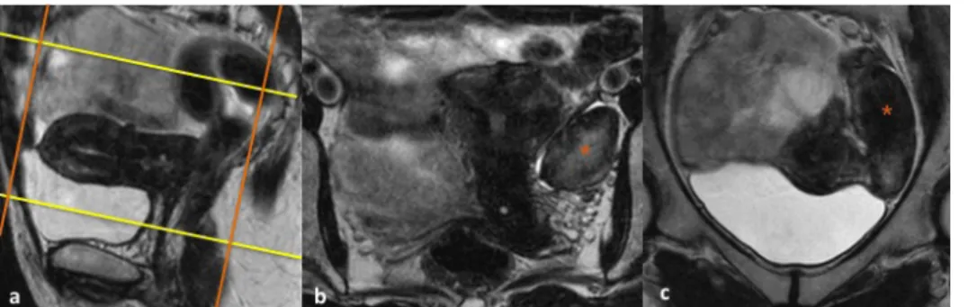 Figura 1 – (a) Sagital T2  de RM pélvica no qual é  marcado o plano coronal  do corpo do útero, paralelo  à cavidade endometrial  (linhas amarelas) que irá  corresponder ao plano/