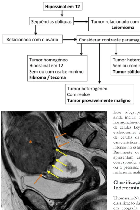 Figura 14 – Sagital T2 de RM pélvica demonstrando volumoso leiomioma  subseroso  no  fundo  uterino  (*),  com  “sinal  da  garra”  pela  presença  de  miométrio envolvendo as suas margens (setas laranja), e sinal da ponte  vascular, pela presença de image