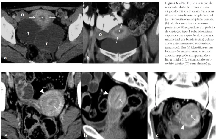Figura 6 – Na TC de avaliação da  ressecabilidade de tumor anexial  esquerdo misto em examinada com  41 anos, visualiza-se no plano axial  (a) e reconstrução no plano coronal  (b) obtidos num tempo venoso  portal (aos 70 segundos) um padrão  de captação ti