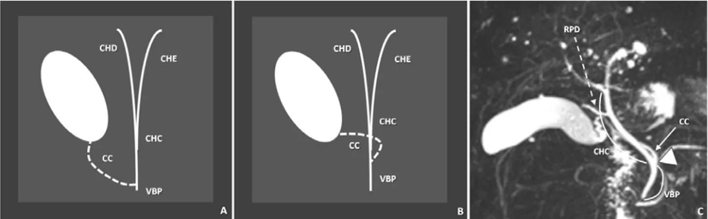 Fig. 6 - “Drenagem do ramo posterior do canal hepático direito no canal hepático comum (A) e no canal cístico (B)”