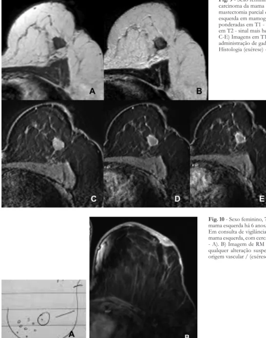 Fig. 9 - Sexo feminino, 65 anos. Antecedentes da carcinoma da mama esquerda há 8 anos, tratado com mastectomia parcial e RT