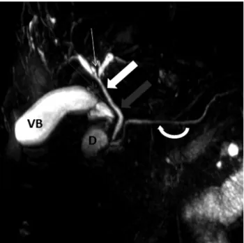 Fig. 2 - Imagem ponderada em T2 sem supressão de gordura no plano coronal (A) e imagem CPRM em 3D (B)