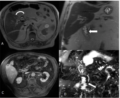 Fig. 5 - Imagens axial (A) e coronal (B) ponderadas em T2 sem saturação de gordura, imagem axial ponderada em T1 com saturação de gordura após adminstração de gadolíneo endovenoso na fase tardia (dez minutos) (C) e imagem MIP da CPRM (D)