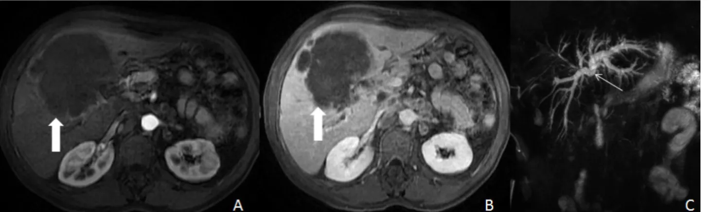 Fig. 8 - Imagens ponderadas em T1 com saturação de gordura após adminstração de gadolíneo endovenoso nas fases arterial (A) e intersticial (B)