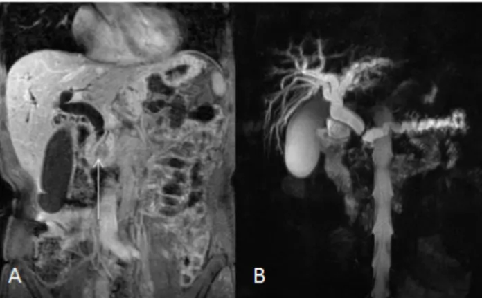 Fig. 12 - Na imagem ponderada em T1 com saturação de gordura na fase intersticial (A), visualiza-se imagem nodular de contornos mal definidos, compatível com neoplasia da cabeça do pâncreas (seta).