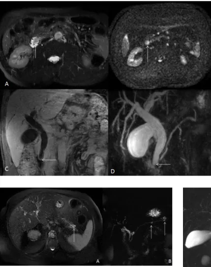 Fig. 15 - A imagem MIP da CPRM demonstra o ducto ventral pancreático (seta fina) sem aparente comunicação com o ducto dorsal (setas grossas), os quais se encontram ligeiramente ectasiados, em virtude da adminstração de secretina